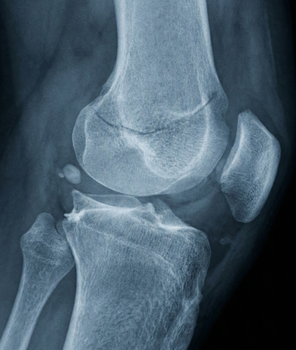 X-ray of knee joint